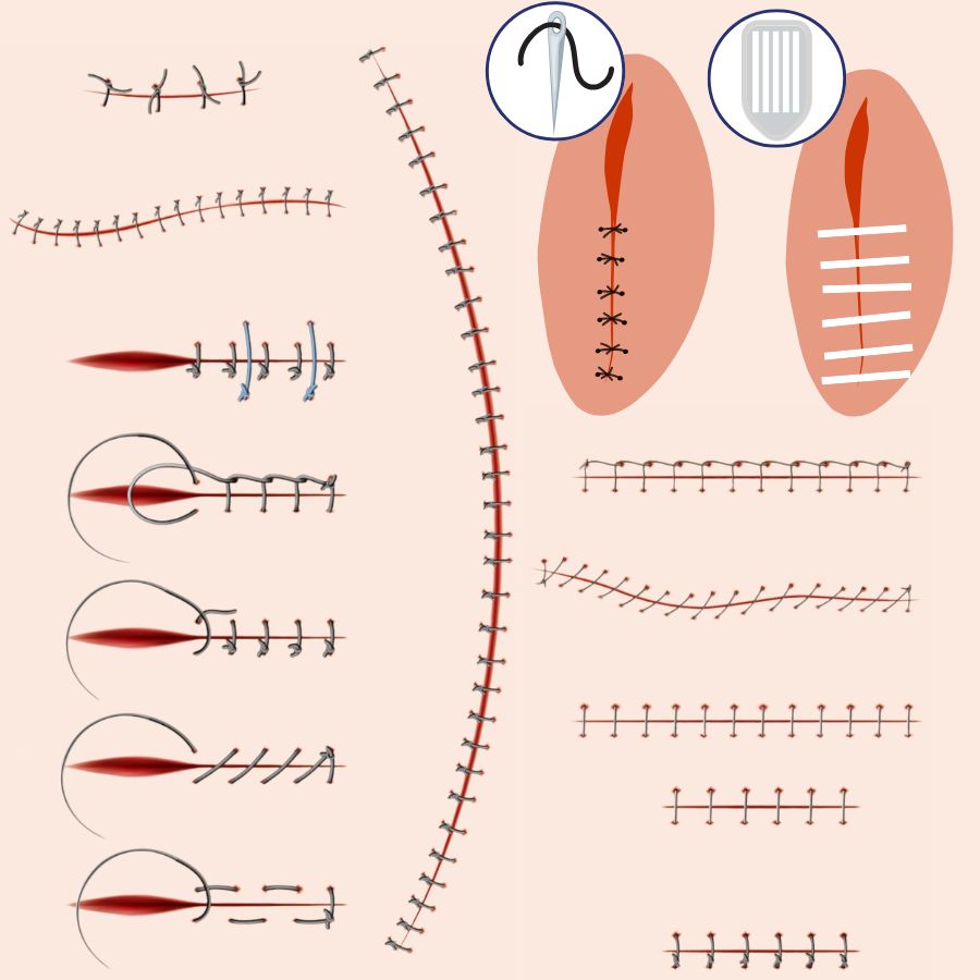 point de suture​